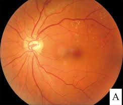 Diabetic Retinopathy Care